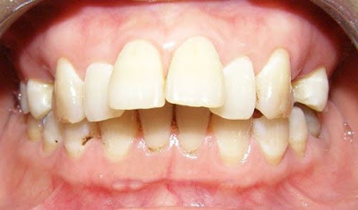 Răng bị hô có nên niềng răng không ?