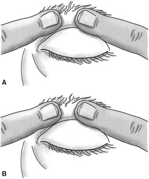 Cpt Code For Laceration Repair Of Eyebrow EyebrowShaper