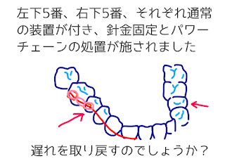 ©さんがつの歯科矯正を始めます　イラスト