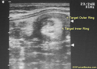 Sudiyatmo,MD Blog & Journal: Invaginasi (Intussusception) pada Dewasa