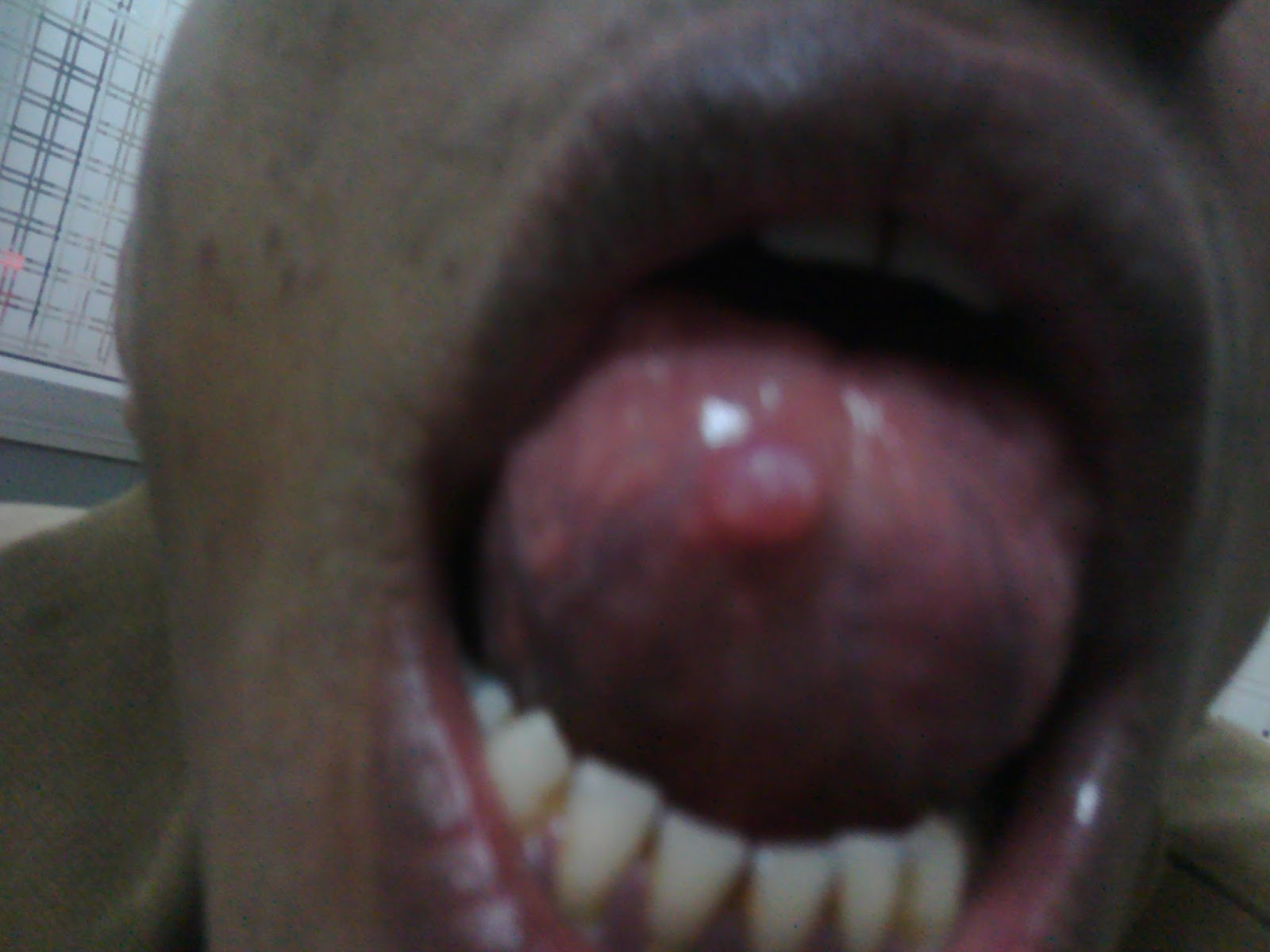 Dr Rahul Singh Homeopathic Physician Health Coach Treatment And Cure Of Mucocele And Ranula With Homoeopathic Medicines Updated In 2021