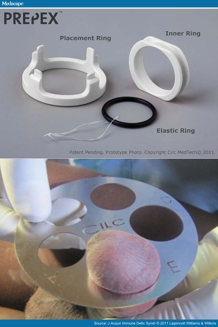 THE EXCLUSIVE WHO okays nonsurgical circumcision devise to slow