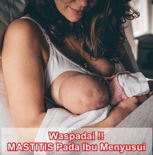 Obat Mastitis (Infeksi Payudara) Untuk Ibu Menyusui Obat Mastitis