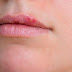 Home Remedies for Cold Sores | How Long Does it Take a Cold Sore to Go Away?