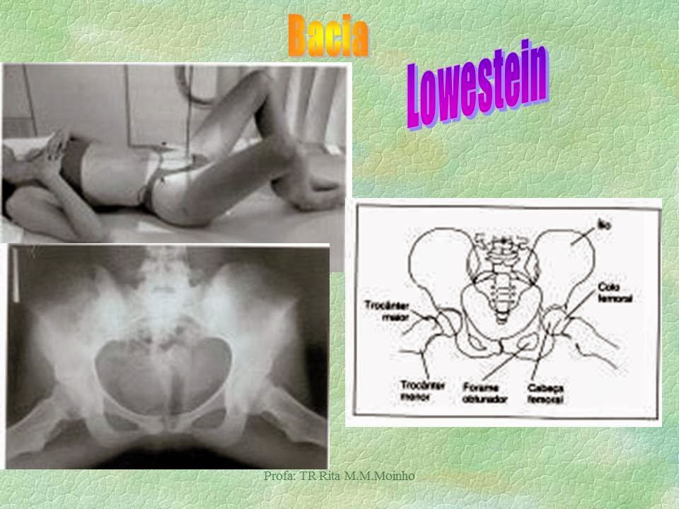 radiologia convencional : Raio-x de Bacia e articulações sacro ilíacas