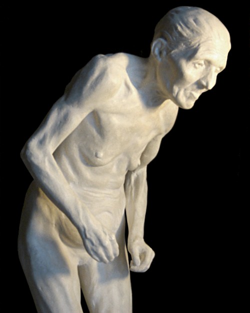 Paul Richer - statuette af gammel kvinde med Parkinsons sygdom