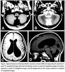 Radiología de hidrocefalia supratentorial Radiología de hidrocefalia supratentorial