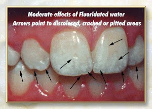 'dental fluorosis' looks like this ...