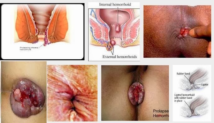 pengobatan wasir obat ambeien