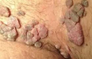 Foto Kutil Kelamin Di Testis