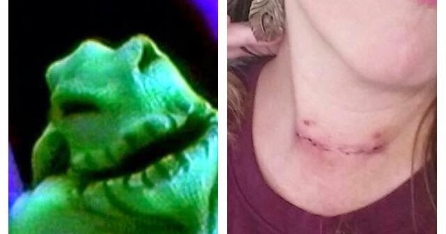 xx victoria Post Surgery Thyroid Removal PostOp Recovery