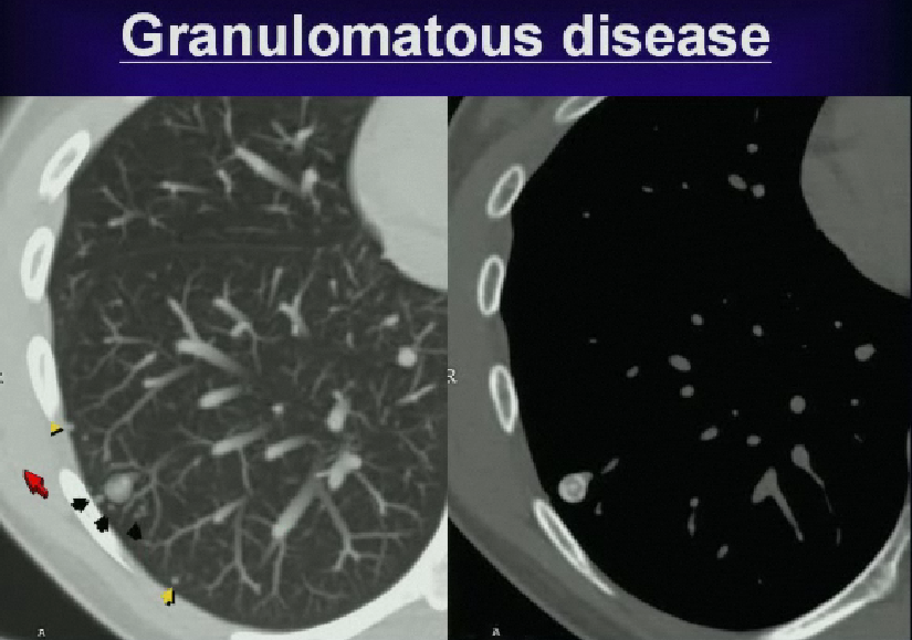 rsna solitary pulmonary nodule