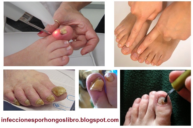 Como es posible quitar el hongo en las uñas