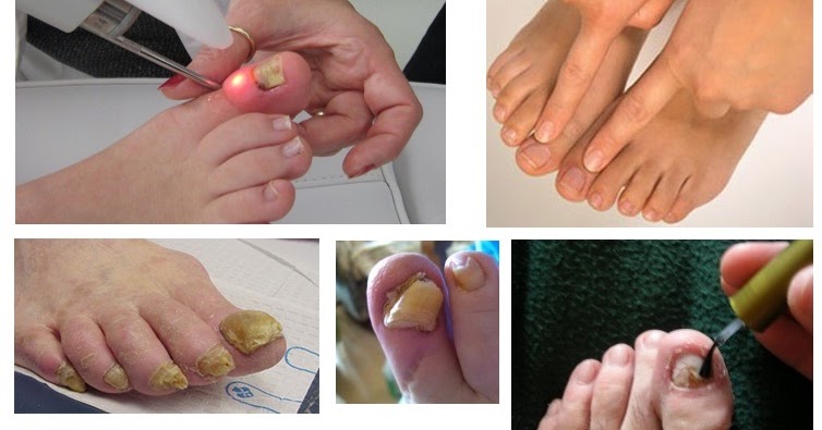 El medio del hongo de las uñas top 5
