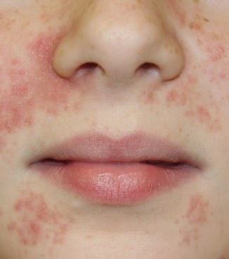 Cheat Sheet - Perioral Dermatitis or 'those red annoying spots that go away' - Caroline Hirons