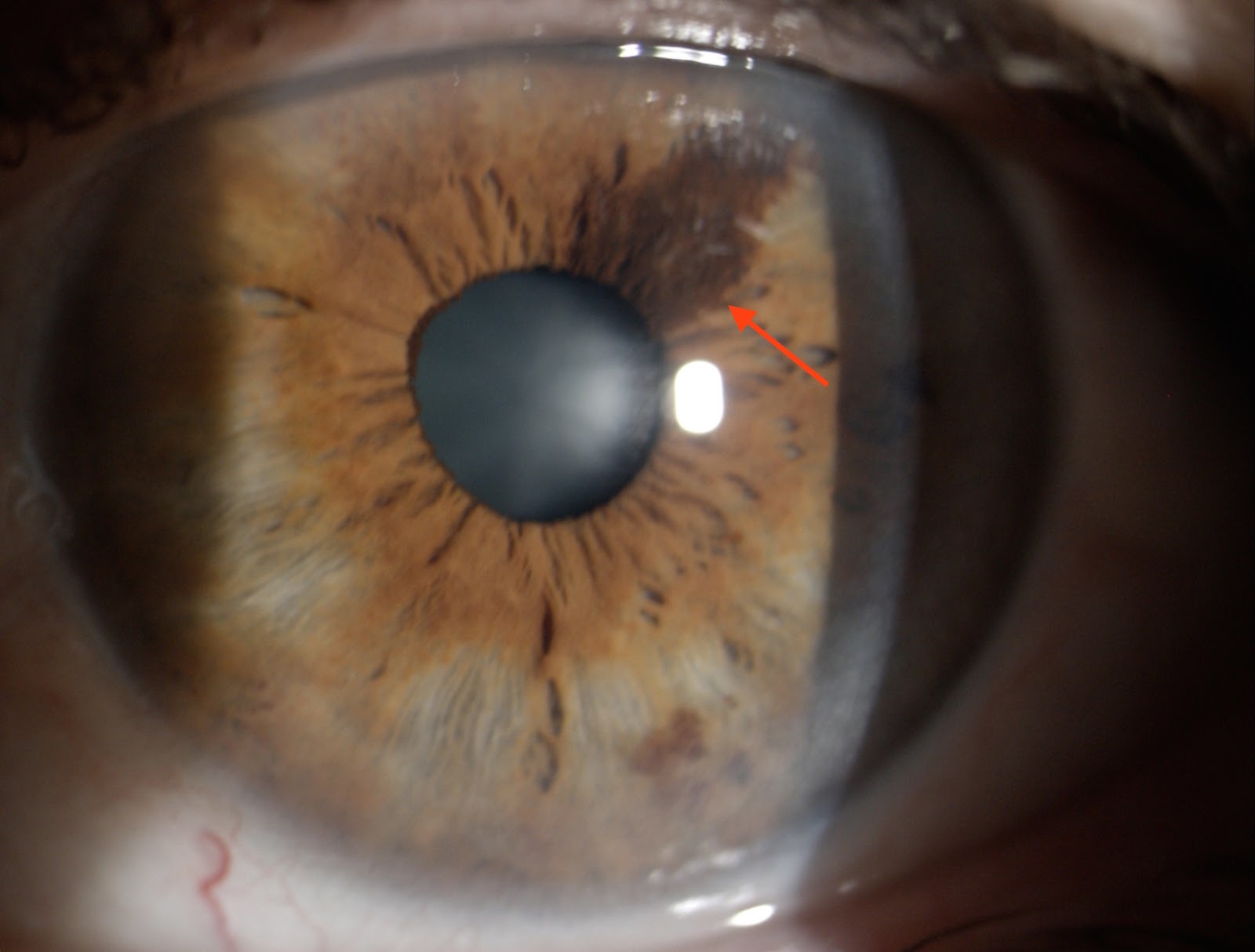 NEVUS DEL IRIS (2 FOTOS)