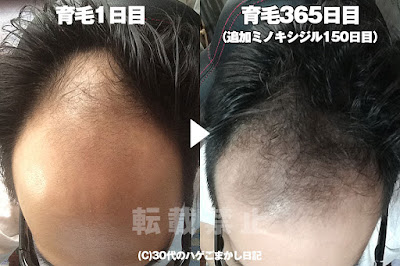 育毛一周年の頭皮