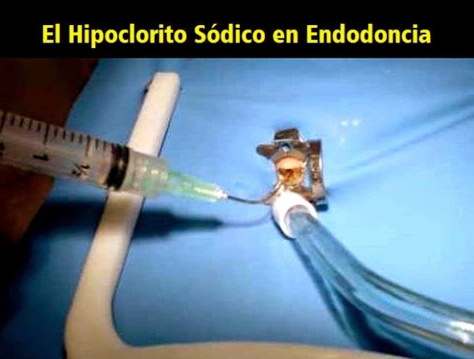 El HIPOCLORITO SÓDICO en Endodoncia - Ventajas y Desventajas