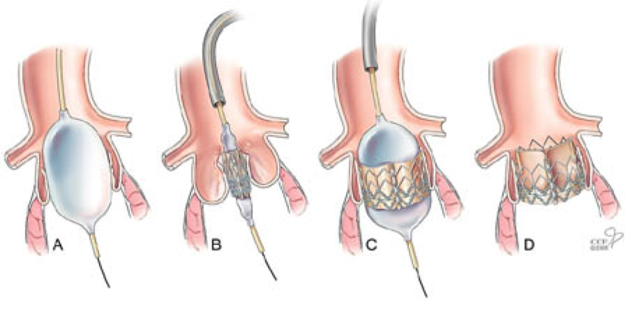 Транскатетерная имплантация аортального клапана. Протез аортального клапана эндоваскулярный. Транскатетерная имплантация аортального клапана Tavi. Операции на аортальном клапане. Как клапан делает операция