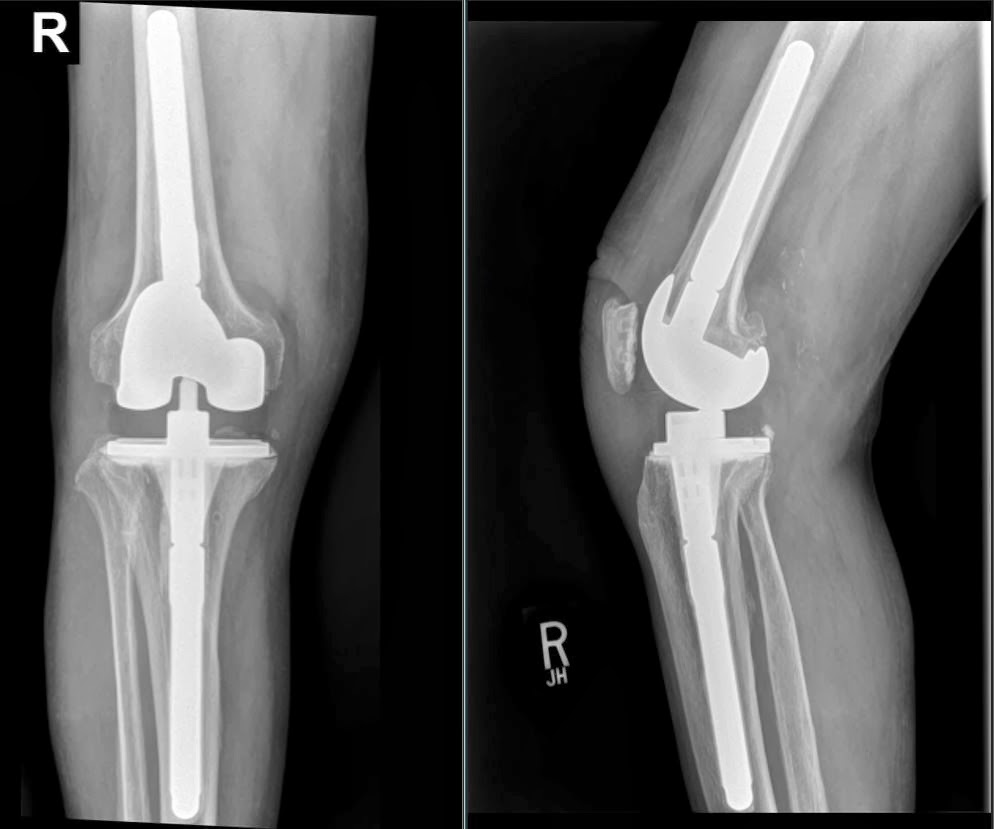 Knee Replacement Lcck Ray Surgery Orthopedic Bowed Xray Stiffness Implants ...