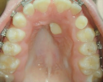 Niềng răng thừa không nhổ răng có hiệu quả không?