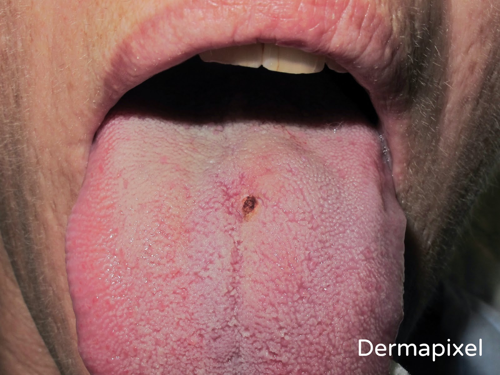 Lesiones de papiloma en la boca Papiloma verrugoso boca