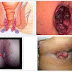 Obat Wasir Ambeven Ampuh Ambeclear thumbnail