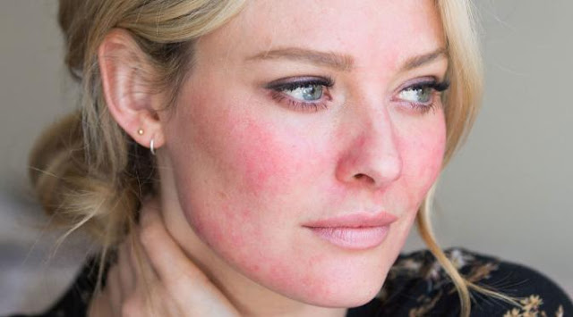 Pengobatan Alami Penyakit Rosacea