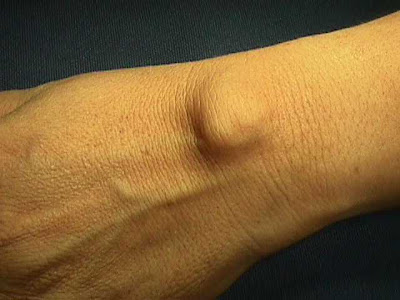 OSSA CARPALIA ©: GANGLION DE LA MUÑECA.