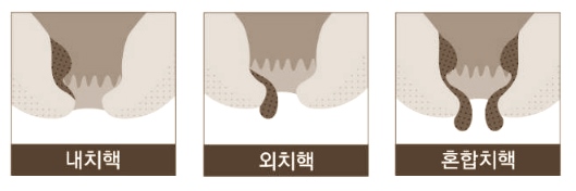 치핵 치핵