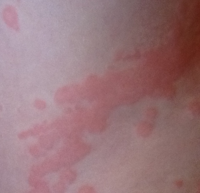 raised rash under armpit