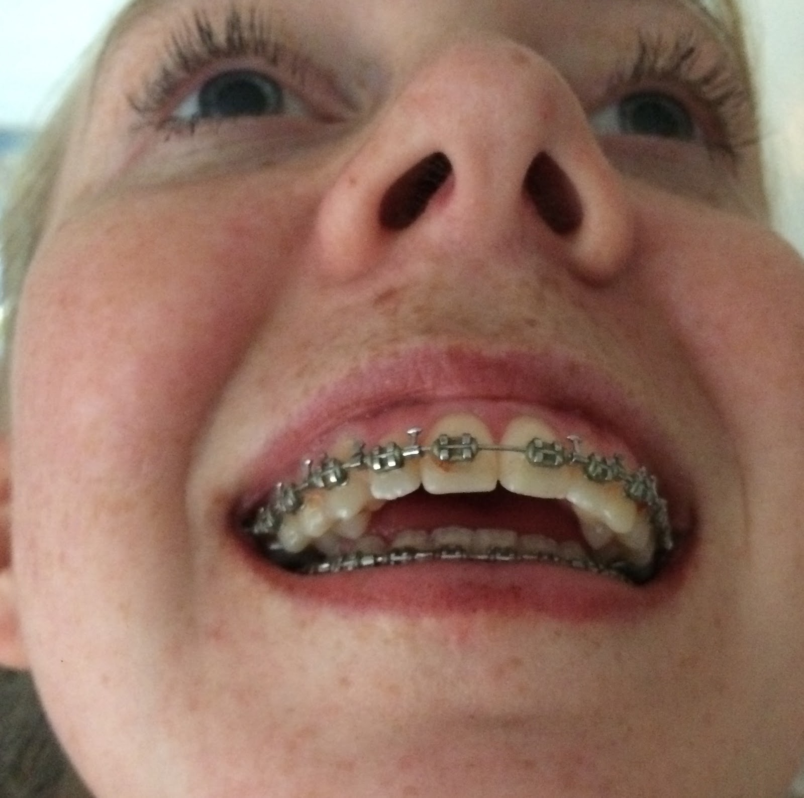 Summer's double jaw surgery blog (NHS) Getting braces