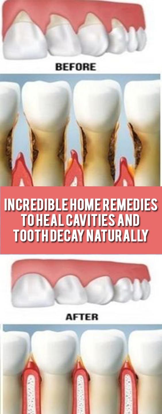 EXPLORE HEALTH Incredible Home Remedies to Heal Cavities and Tooth