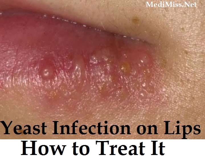 Home Remedies For Lip Infection – Symptoms Of Fungal ...