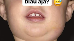 Anak gondongan dikasi blau? Baca dulu fakta ilmiahnya..