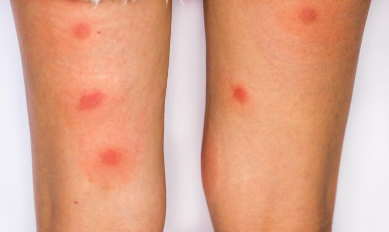 Manchas Vermelhas nas Pernas: 6 Causas e Remédios Caseiros