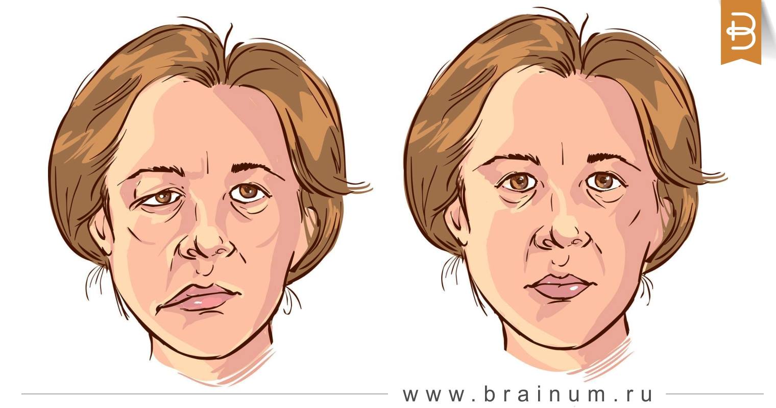 Первые признаки инсульта у женщин. Нужно действовать