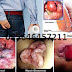 Obat Merk Ambejoss Untuk Wasir thumbnail