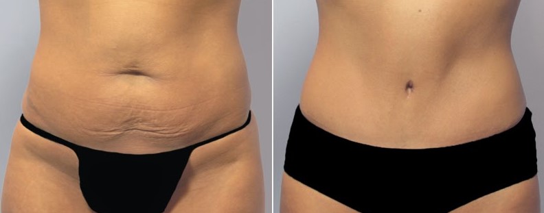 how much does a tummy tuck cost what determines the ultimate how much does a tummy tuck cost what determines the ultimate
