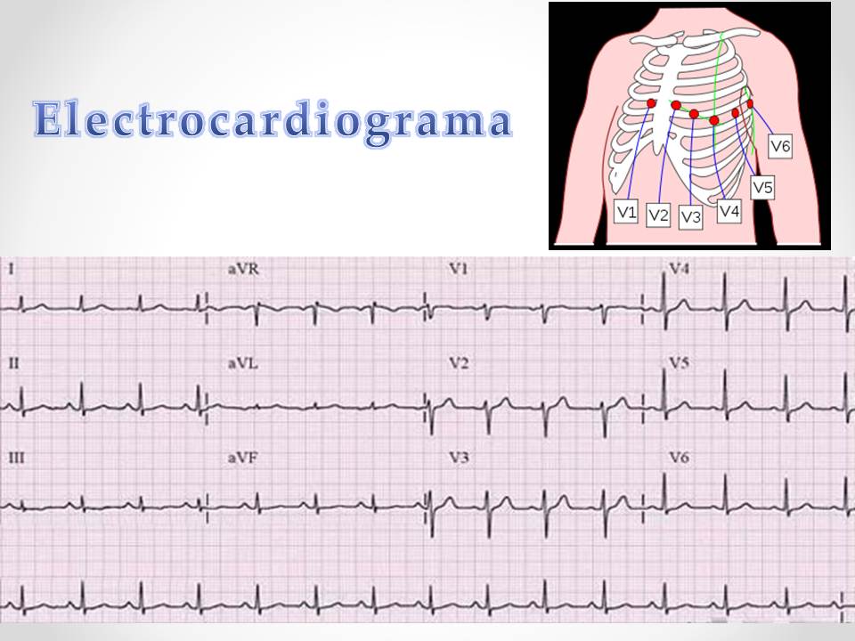 Como Interpretar Um Eletrocardiograma