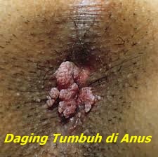 Image Daging Tumbuh Di Anus Dan Cara Mengobatinya