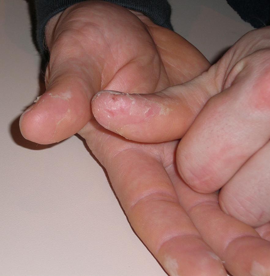 تثقيف نفسك حول علاج تقشر الجلد على الأصابع