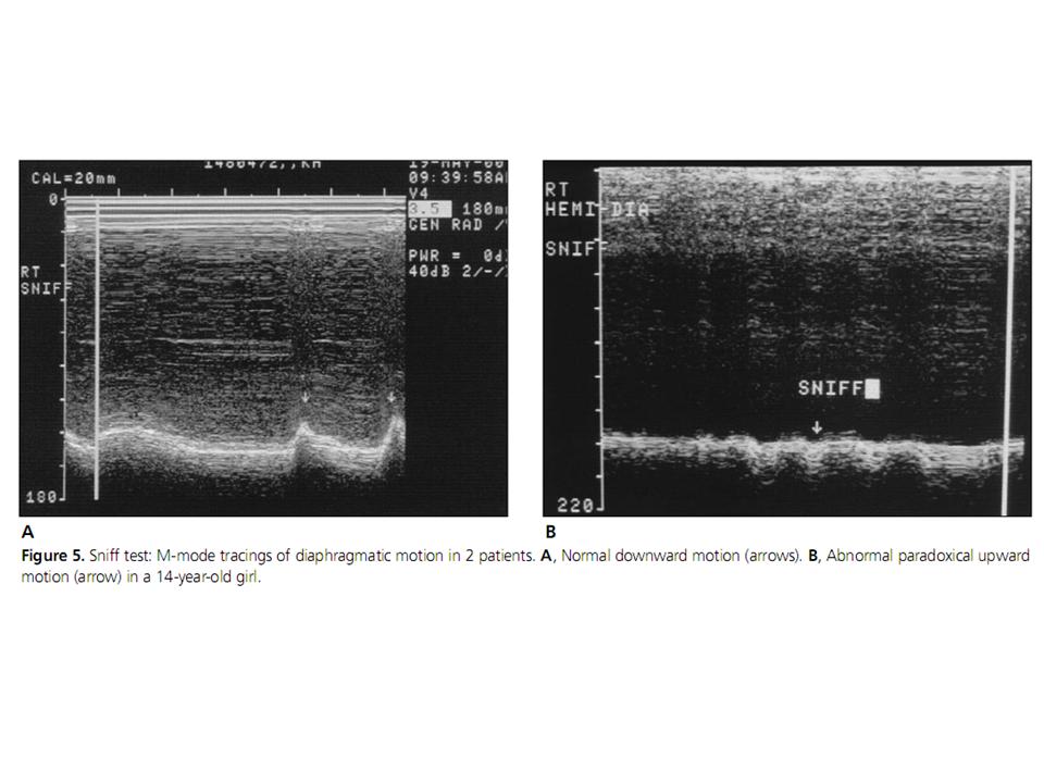 BÀI SOẠN VỀ SIÊU ÂM CHẨN ĐOÁN: DIAPHRAGMATIC PARALYSIS: M mode US and ...