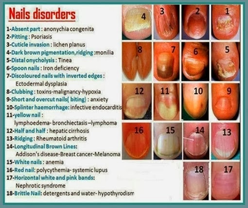 The Wealth of Health 17 Nail Disorders