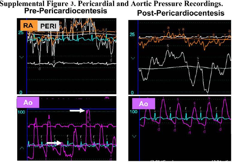 hipertrofia ventricular izquierda ecg emedicina diabetes hipertrofia ventricular izquierda ecg emedicina diabetes