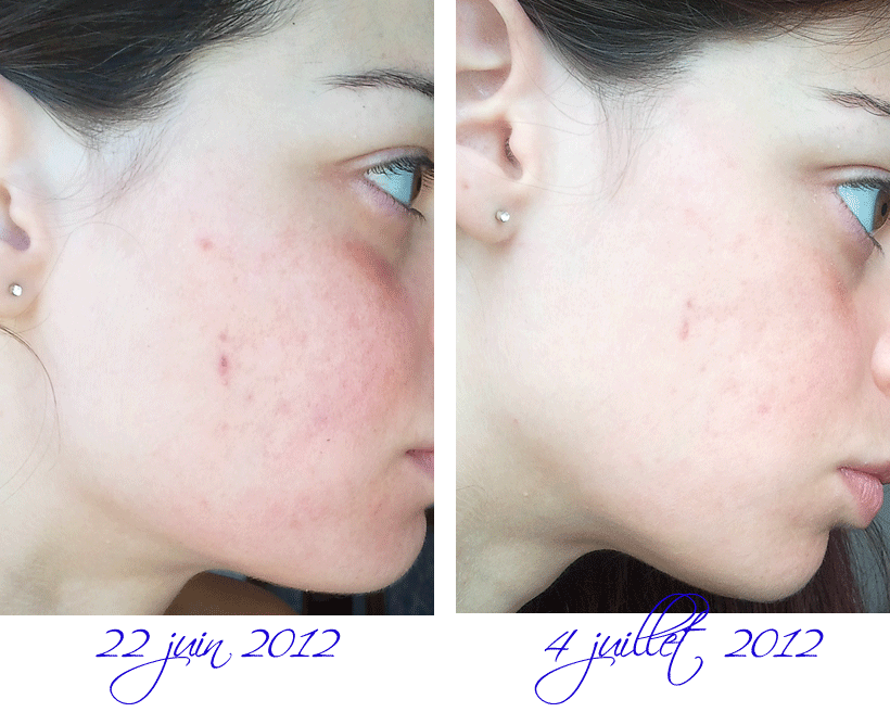 Longs Cheveux Au Naturel Les Aha Une Astuce Miracle Pour L Acne