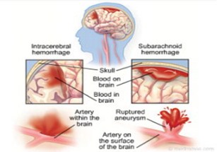 Manfaat Daun Karet Kebo Untuk Stroke gambar daun karet kebo, cara mengolah daun karet kebo, manfaat daun karet kebo bagi kesehatan, karet kebo untuk stroke, cara merebus daun karet kebo