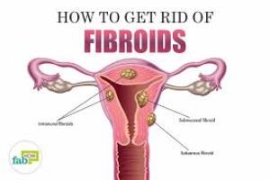 CAUSES OF FIBROIDS   Experts cannot come to a common consensus about why fibroids occur.     1- Family history: Women whose mothers and/or sisters have/had fibroids have a higher risk of developing them too.  2- Pregnancy 3- Hormone