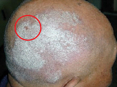 remedios caseros psoriasis cuero cabelludo remedios caseros para la psoriasis capilar psoriasis en remedios caseros psoriasis cuero cabelludo remedios caseros para la psoriasis capilar psoriasis en