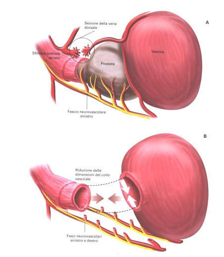 dimensione del pene dopo chirurgia prostatica